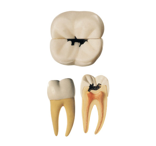 右側(cè)第一顆磨牙蛀牙模型